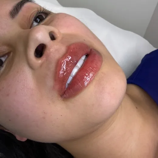 Depois — Preenchimento Labial